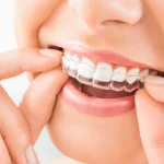 Aparat nakładkowy Invisalign