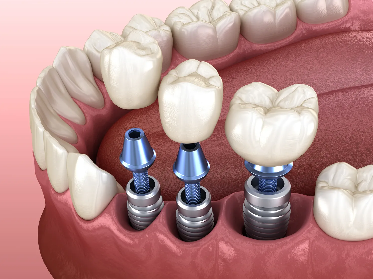 Dentysta Szczecin implanty